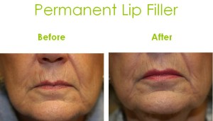 Before and After of a patient with a permanent Lip Enhancement/Filler