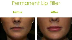 Before and After of a patient with a permanent Lip Enhancement/Filler