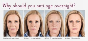 sculptra progresion pictures