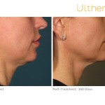 Before and After of a patient with Ultherapy Skin Tightening Treatment
