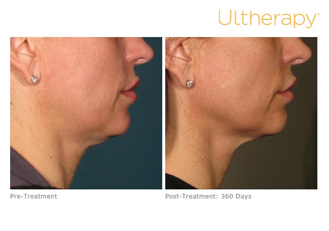Before and After of a patient with Ultherapy Skin Tightening Treatment