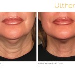 Before and After of a patient with Ultherapy Skin Tightening Treatment