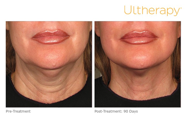 Before and After of a patient with Ultherapy Skin Tightening Treatment
