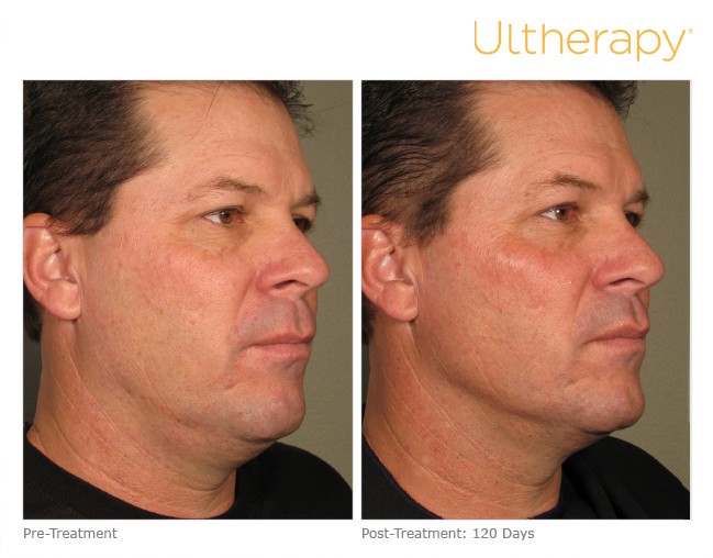 Before and After of a patient with Ultherapy Skin Tightening Treatment