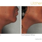 Before and After of a patient with Ultherapy Skin Tightening Treatment