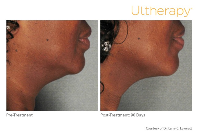 Before and After of a patient with Ultherapy Skin Tightening Treatment