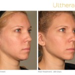 Before and After of a patient with Ultherapy Skin Tightening Treatment