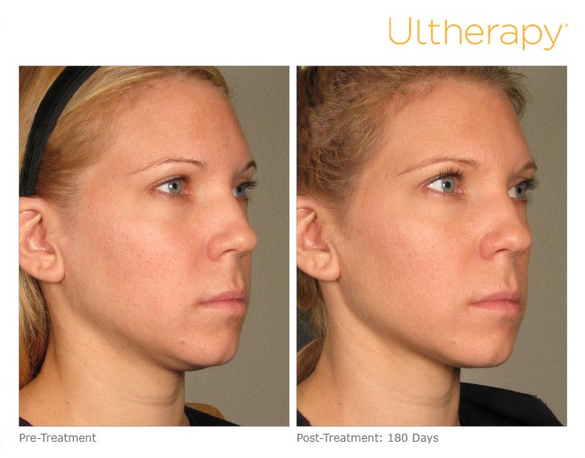 Before and After of a patient with Ultherapy Skin Tightening Treatment