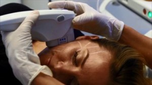 A woman getting an ultherapy skin tightening treatment