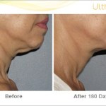 Before and After of a patient with Ultherapy Skin Tightening Treatment