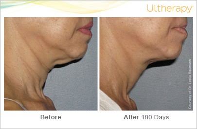 Before and After of a patient with Ultherapy Skin Tightening Treatment