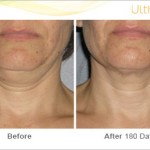 Before and After of a patient with Ultherapy Skin Tightening Treatment