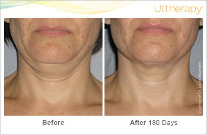Before and After of a patient with Ultherapy Skin Tightening Treatment