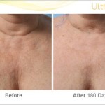 Before and After of a patient with Ultherapy Skin Tightening Treatment