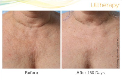 Before and After of a patient with Ultherapy Skin Tightening Treatment