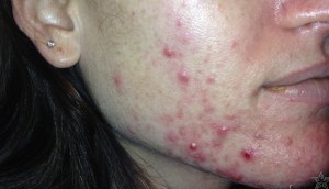 a woman before Celluma LED Therapy
