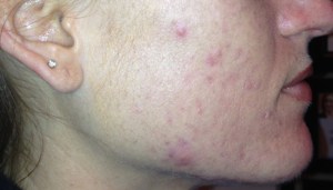 a woman after Celluma LED Therapy