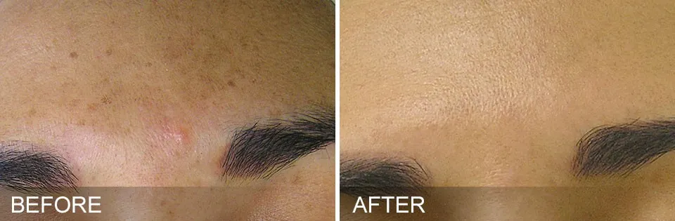 Before and After of a patient getting HydraFacial