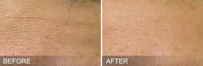 Before and After of a patient getting HydraFacial