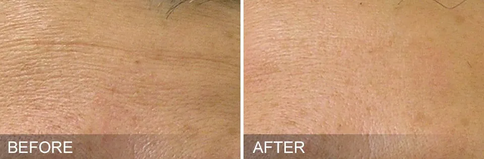 Before and After of a patient getting HydraFacial