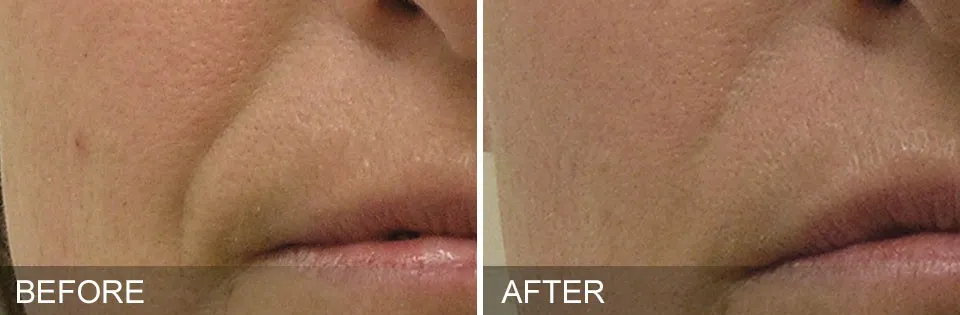 Before and After of a patient getting HydraFacial