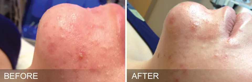 Before and After of a patient getting HydraFacial