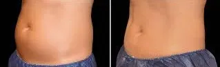 before and after Coolsculpting for Abdomen