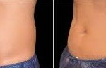 before and after Coolsculpting for Abdomen 