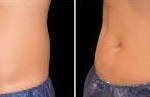 before and after Coolsculpting for Abdomen 