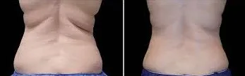 before and after Coolsculpting for Backrolls