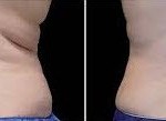 before and after Coolsculpting for Backrolls