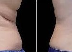 before and after Coolsculpting for Backrolls