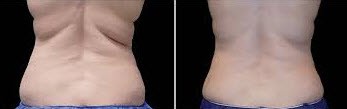 before and after Coolsculpting for Backrolls