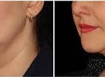 before and after Coolsculpting to Neck