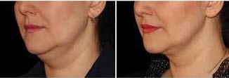 before and after Coolsculpting to Neck