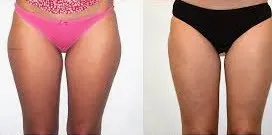 before and after Coolsculpting to Thighs