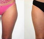 before and after Coolsculpting to Thighs 