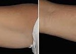 before and after Coolsculpting to Upper Arm