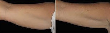 before and after Coolsculpting to Upper Arm