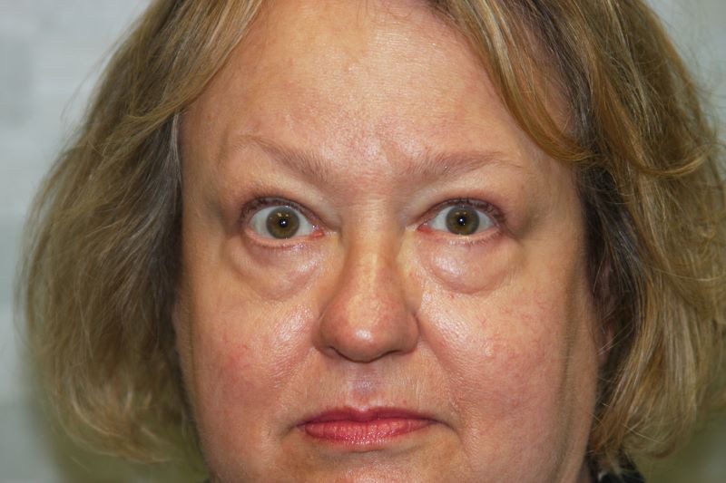 Before 4 Lid Eyelid Lift