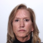 After 4 Lid Eyelid Lift