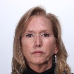 After 4 Lid Eyelid Lift