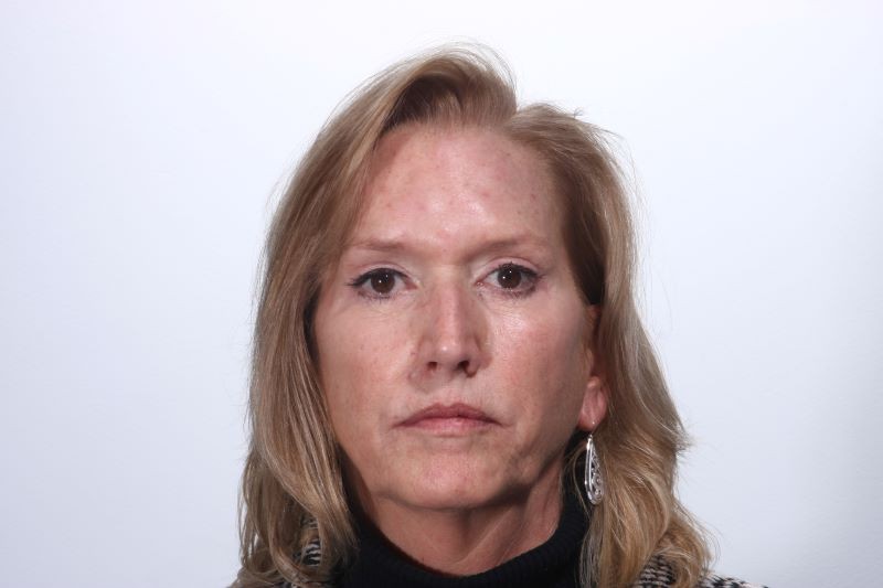 After 4 Lid Eyelid Lift