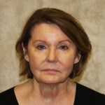 After 4 Lid Eyelid Lift