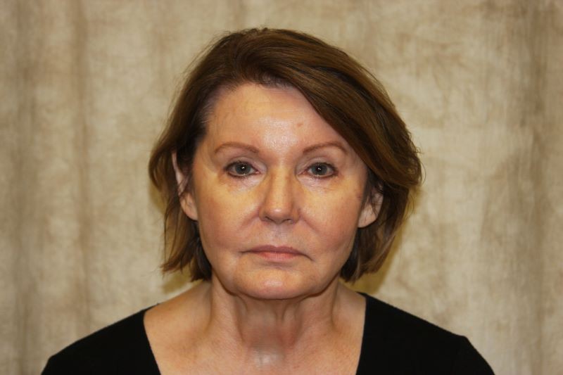 After 4 Lid Eyelid Lift
