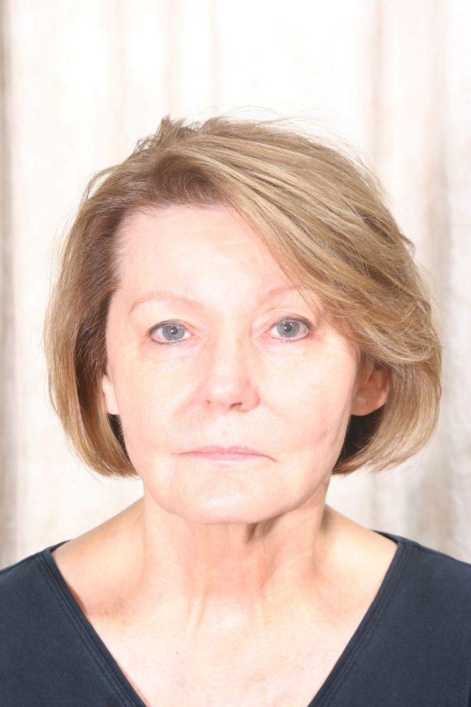 Before 4 Lid Eyelid Lift
