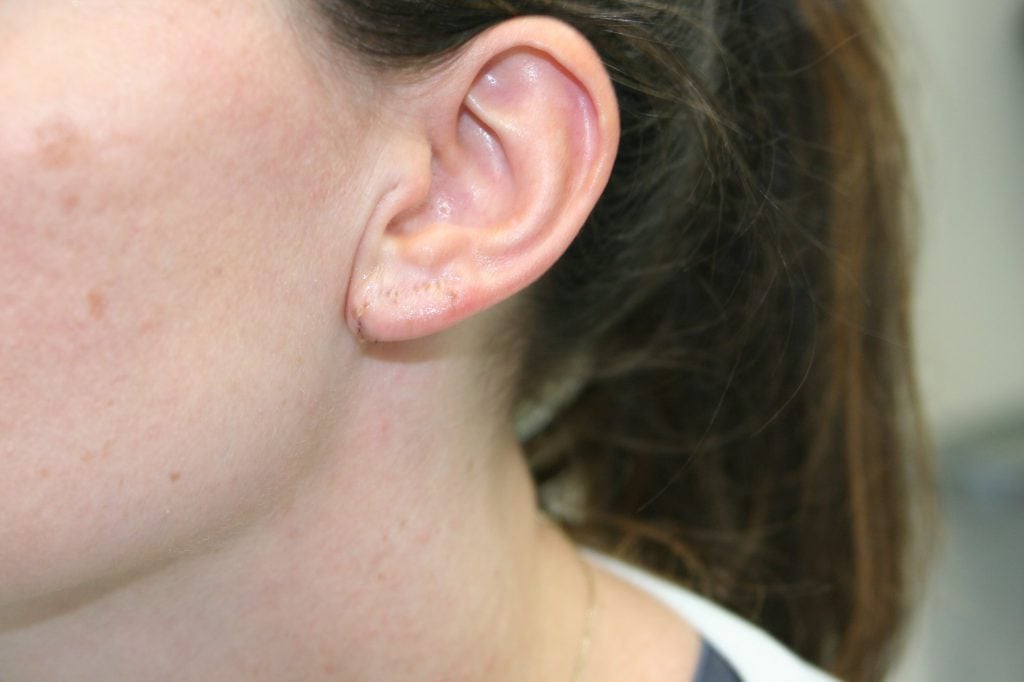 after earlobe repair