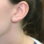 after earlobe repair