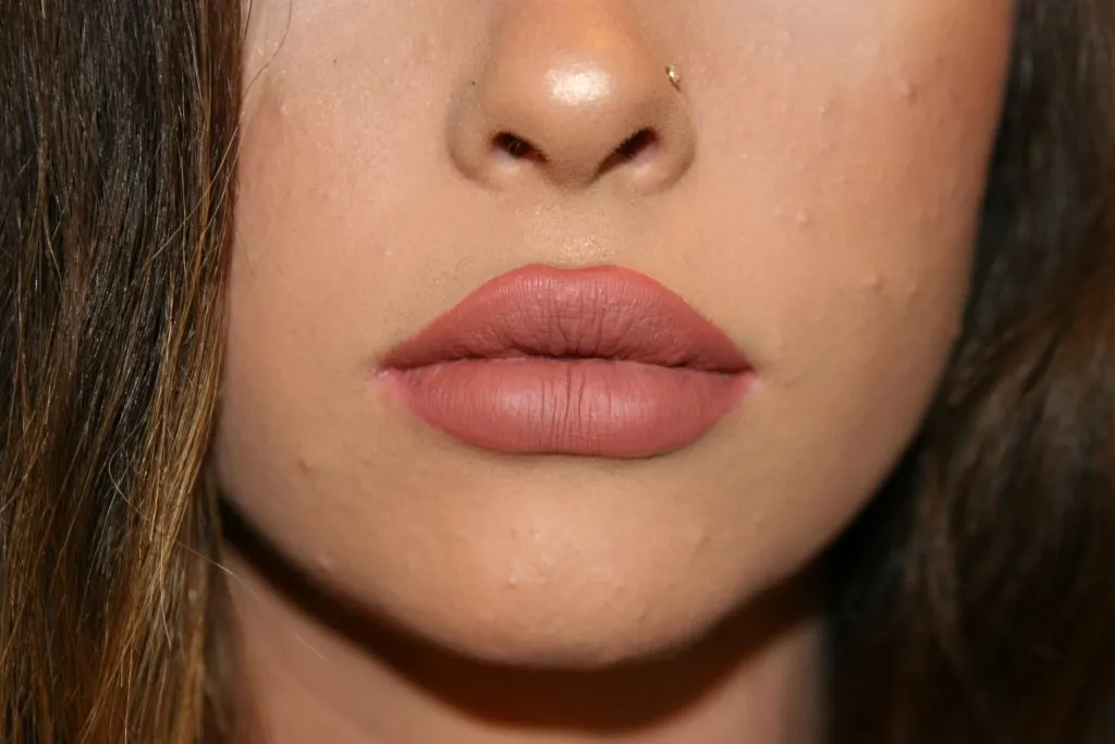 After Lip Enhancement