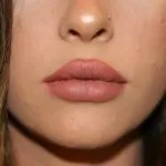 After Lip Enhancement